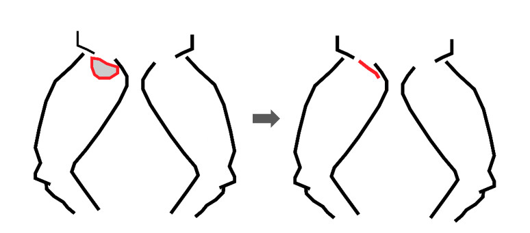 การผ่าต้นขาย้อยแบบแผลแนวนอน