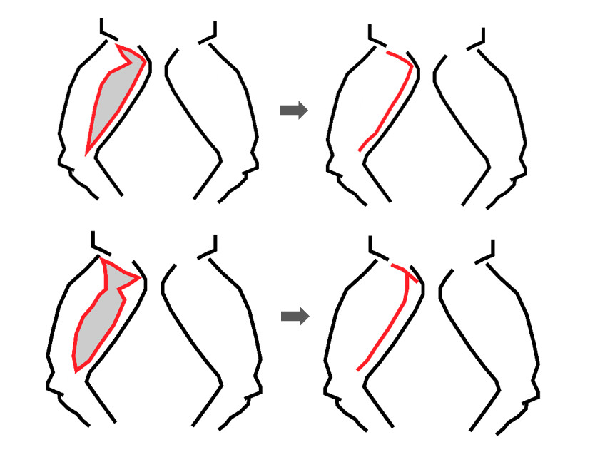 การผ่าตัดต้นขาย้วยแบบแผลแนวนอนร่วมกับแนวตั้ง
