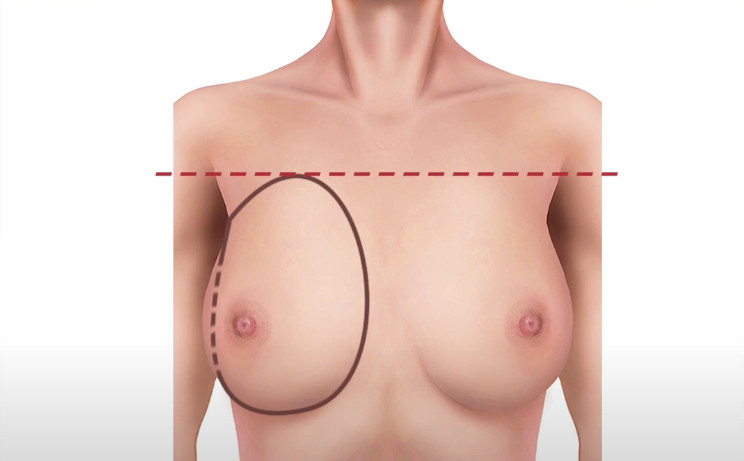 ขอบเขตเต้านมด้านบน