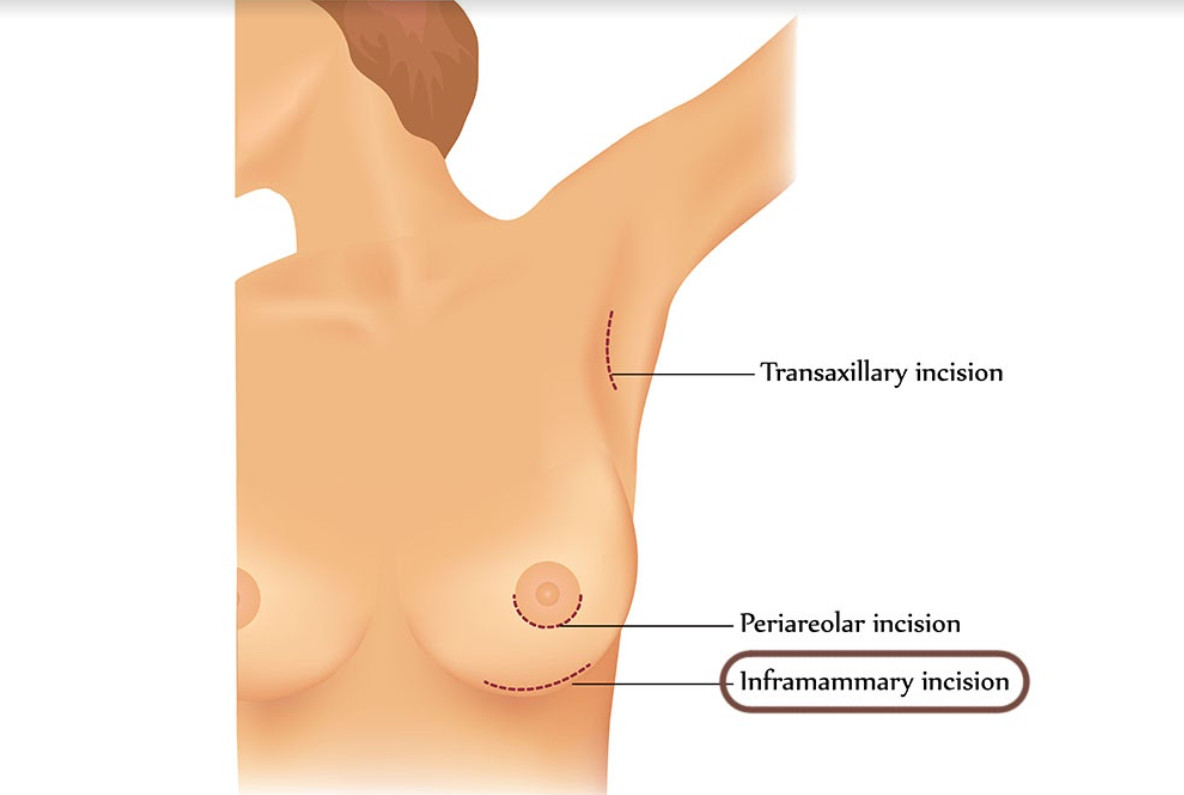 ผ่าตัดเสริมหน้าอก แผลใต้ราวนม