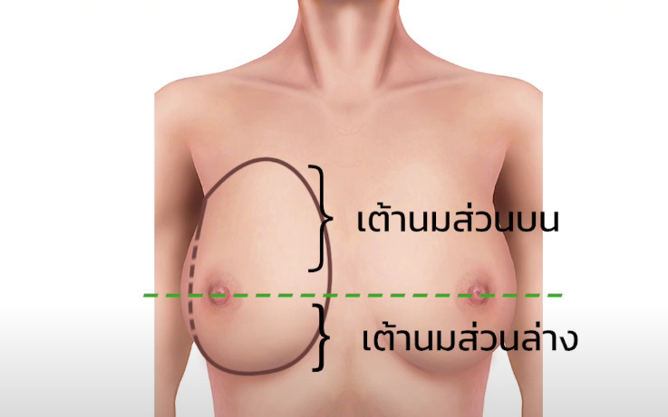 เต้านมส่วนบนและส่วนล่าง
