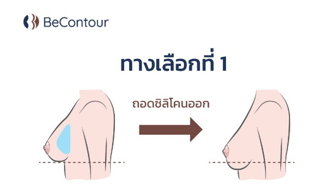 ถอดซิลิโคนออกอย่างเดียว