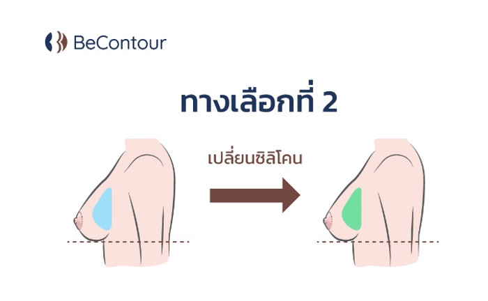 การเปลี่ยนซิลิโคน