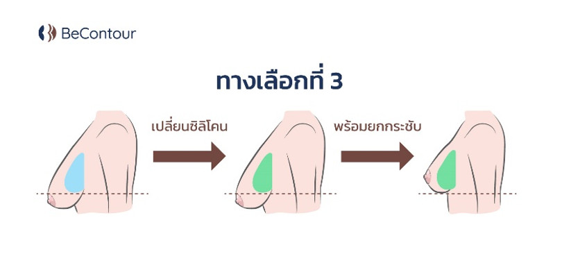 การเปลี่ยนซิลิโคนพร้อมยกกระชับ