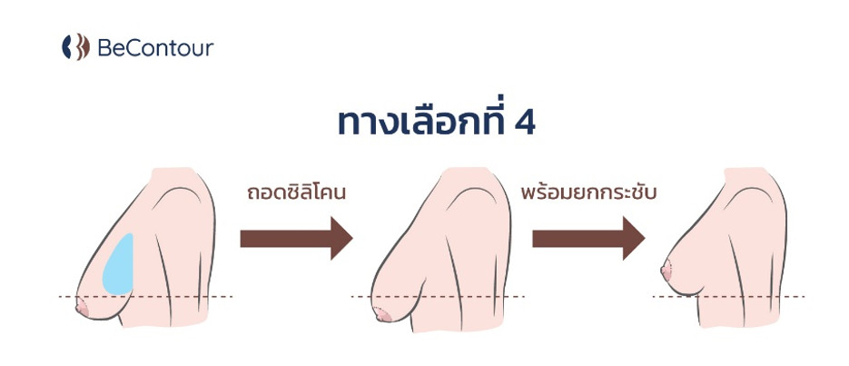 การถอดซิลิโคนเดิมออก และยกกระชับด้วย