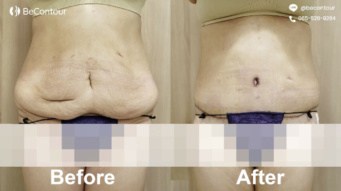 รีวิวตัดหนังหน้าท้อง 360 องศา