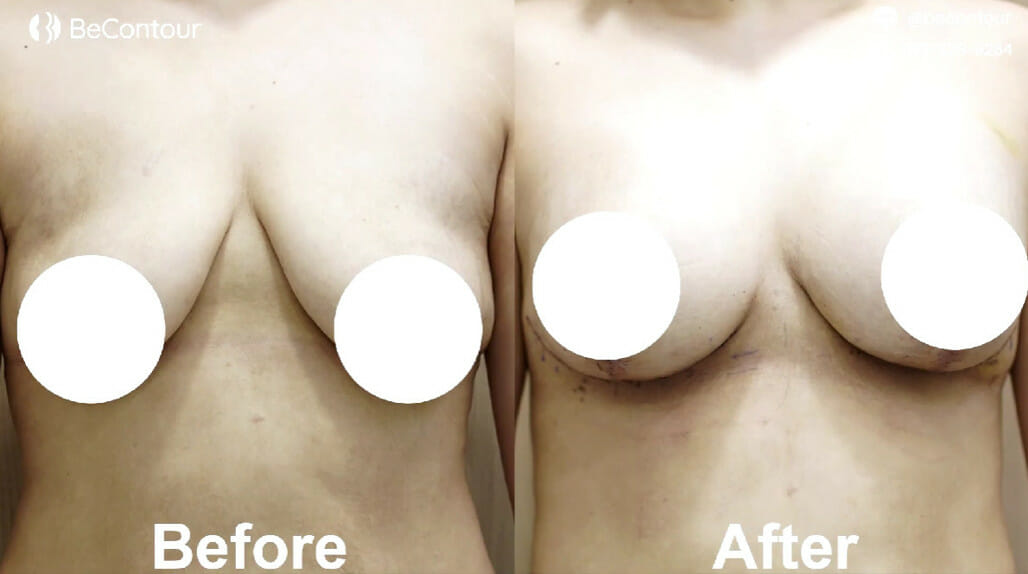 รีวิว ยกกระชับหน้าอก