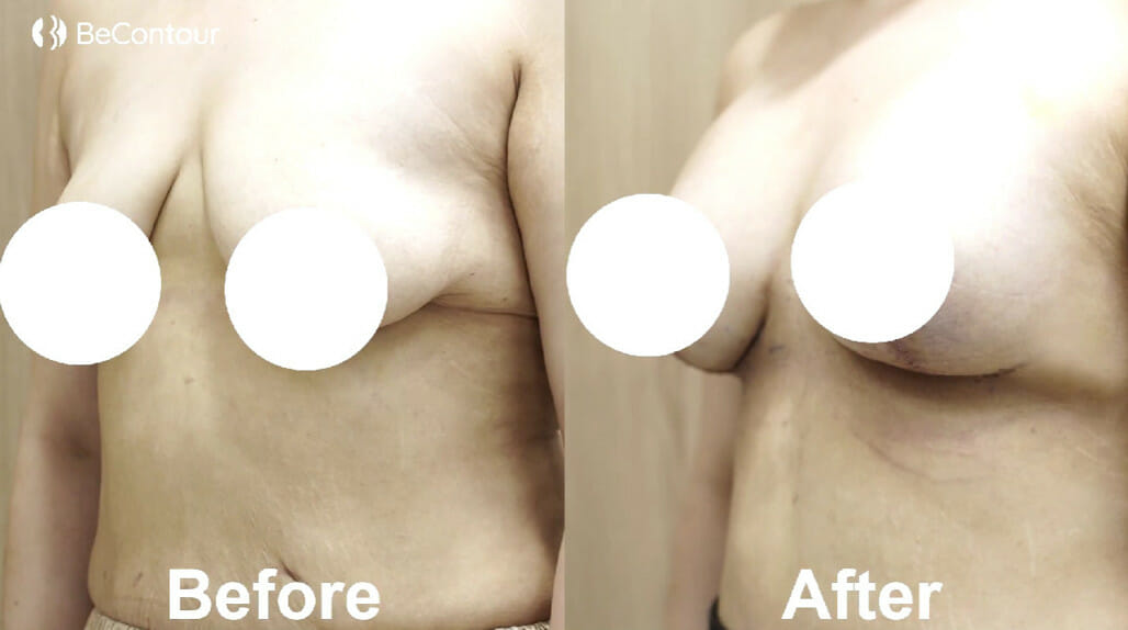 รีวิว ยกกระชับหน้าอก