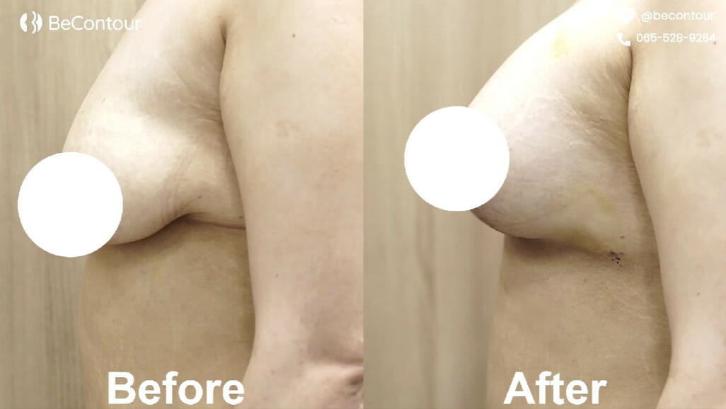 รีวิว ยกกระชับหน้าอก