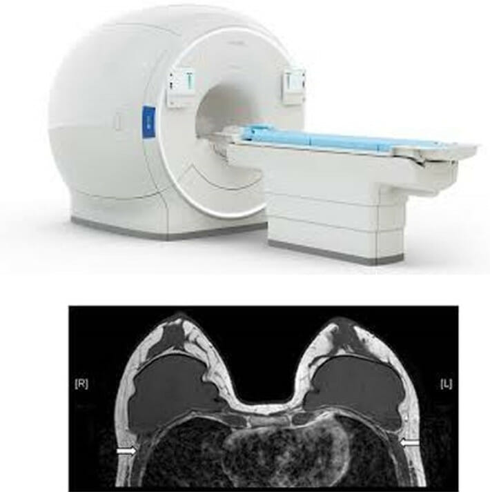 ทำ MRI เพื่อดูหน้าอก