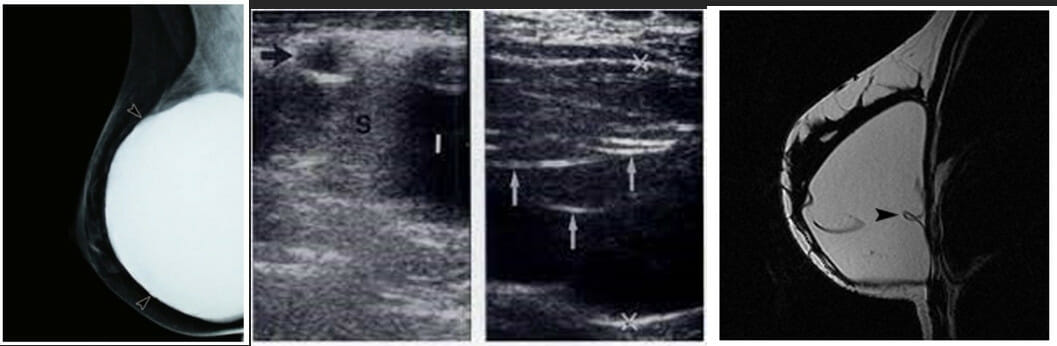 การทำ Mammogram, Ultrasound (US) และ MRI