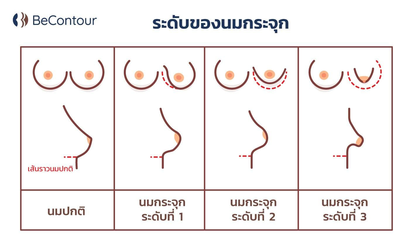 ระดับของนมกระจุก