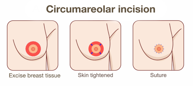 การยกกระชับด้วยแผลรอบปานนม หรือเรียกว่า donut lift