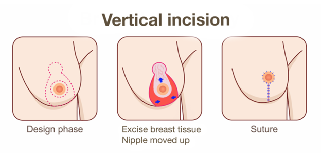 แผลรอบหัวนมและมีแนวตั้งลงมาตรงๆ หรือ lollipop