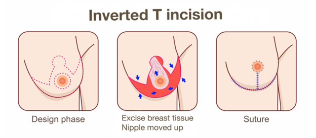 แผลรูปสมอเรือ หรือ inverted T