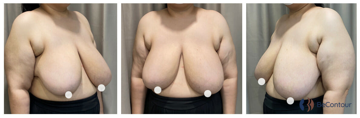 ลดขนาดเต้านม