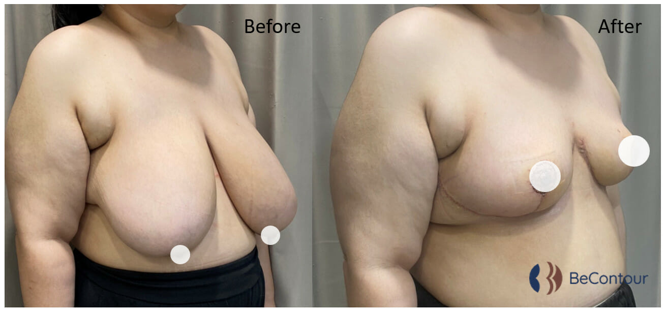 รีวิวลดขนาดหน้าอกใหญ่ พร้อมปลูกถ่ายย้ายหัวนม และปานนม