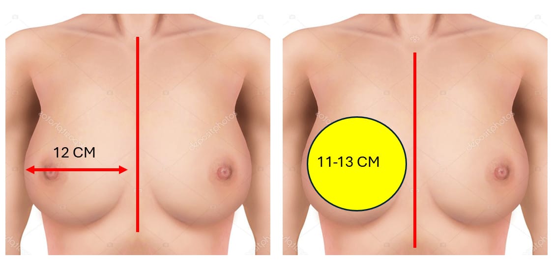 เลือกซิลิโคนก็ใช้หลักเหมือนปกติคือ ดูจากฐานเต้านม