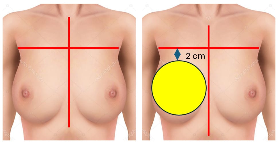 ถ้าซิลิโคนฐานเล็กเกินไป ก็ไม่เกิดเนินเพียงพอ