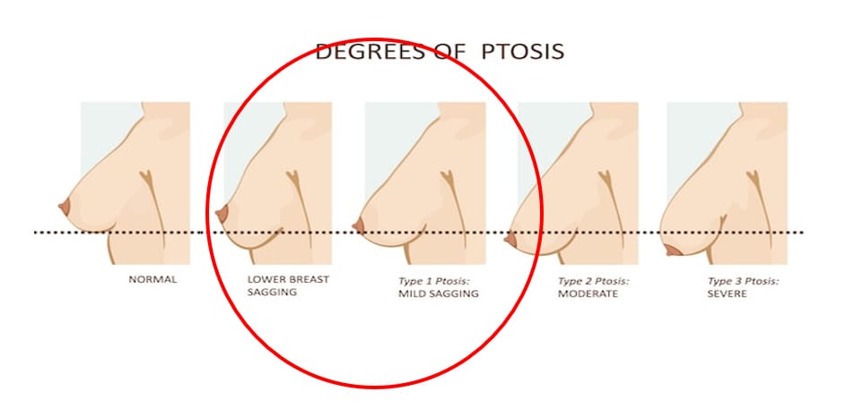 หน้าอกหย่อนคล้อยไม่มาก