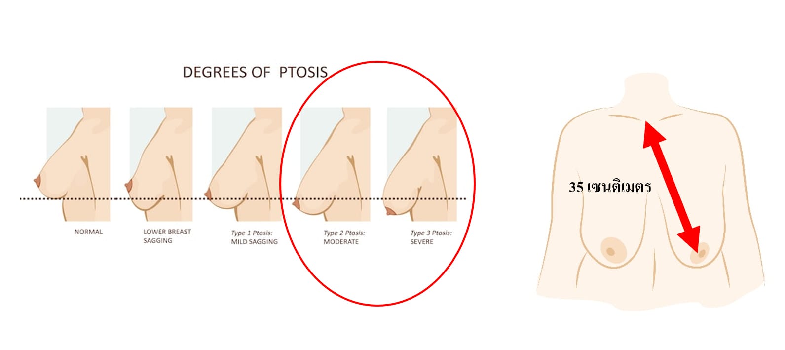 คุณภาพผิวหนัง และเนื้อหน้าอกหย่อนมาก
