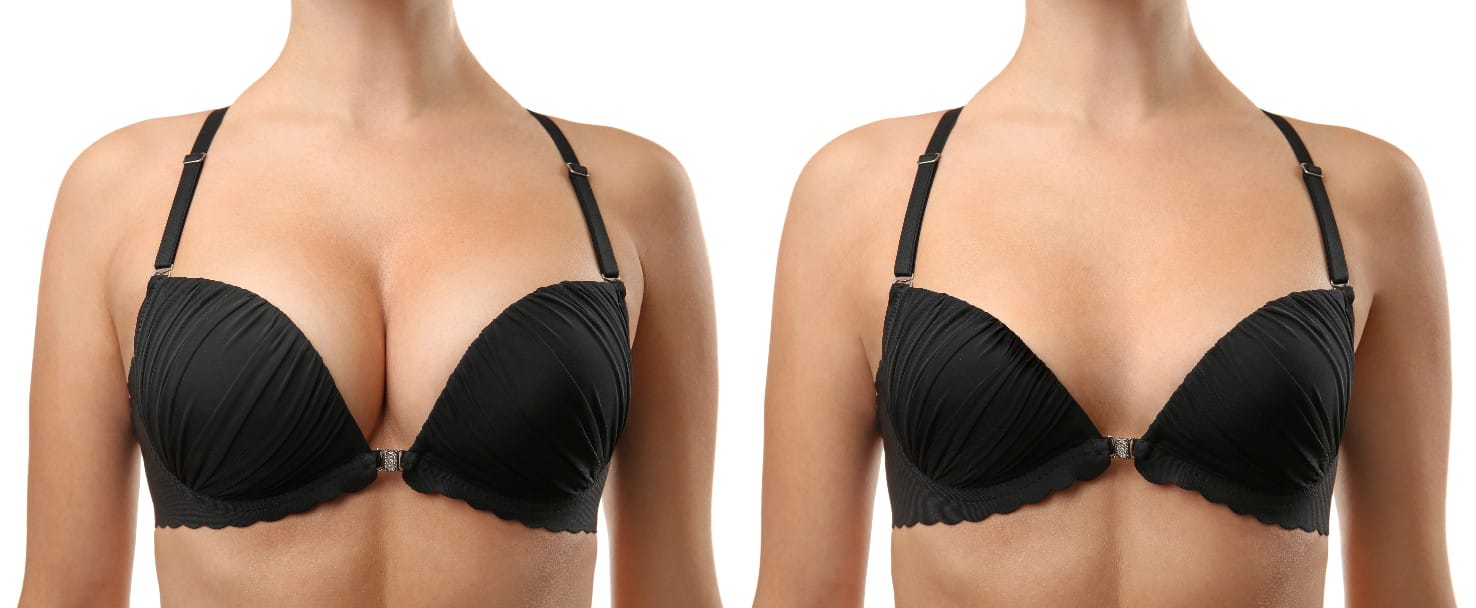 การลดขนาดหน้าอก