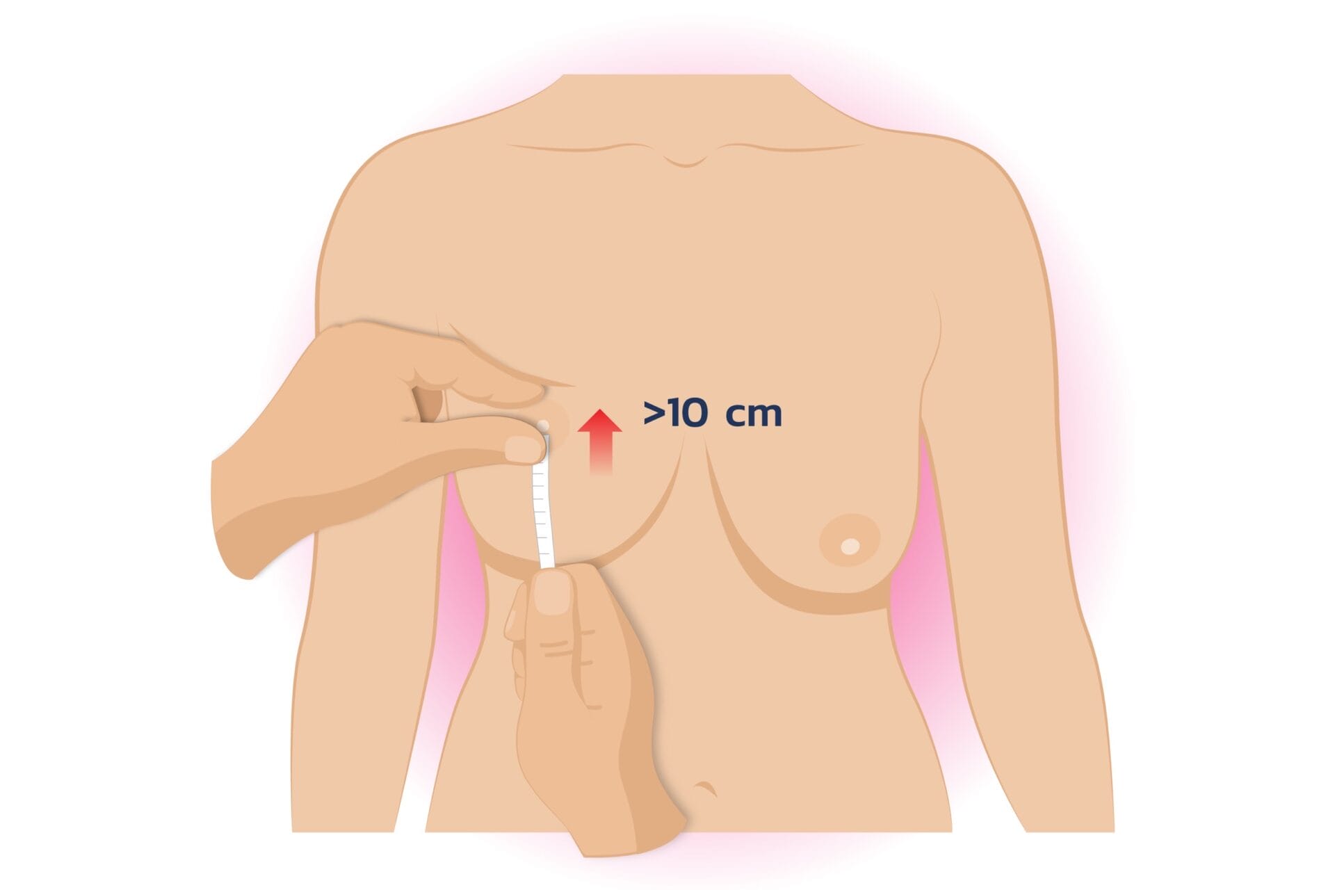 แสดงการวัดระยะระหว่างหัวนมและราวนม