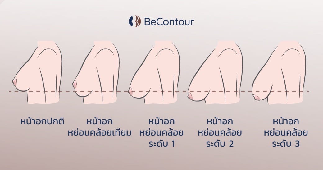 ระดับต่างๆของเต้านมหย่อน และเต้านมหย่อนเทียม