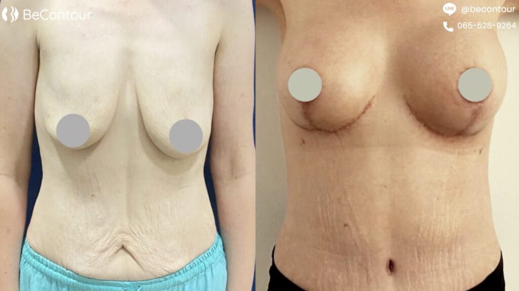 หน้าอกหย่อนคล้อย หลังลดน้ำหนัก