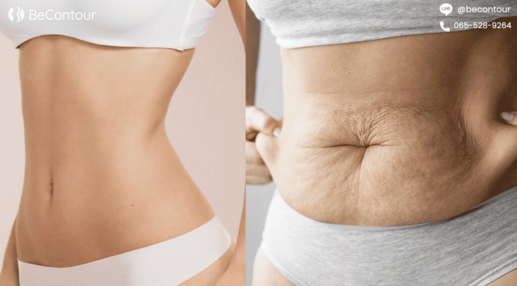 ผิวหนังหย่อนคล้อย หลังลดน้ำหนัก