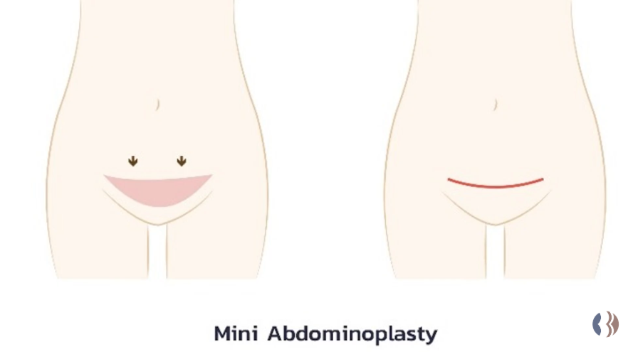 แผลผ่าตัดยกกระชับหน้าท้อง แบบที่ 1 Mini Abdominoplasty