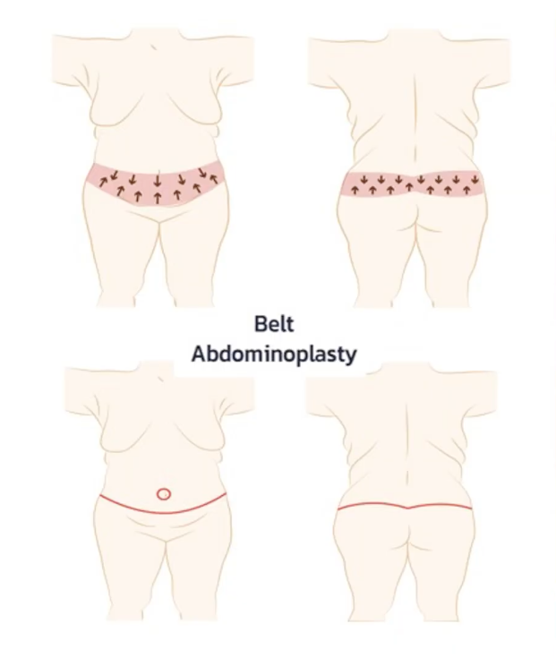 แผลยกกระชับหน้าท้อง แบบที่ 3 Belt Lipectomy